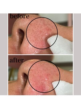 毛穴専科/ワックス脱毛メンズok/沖縄/那覇