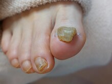 爪切り屋 足楽/肥厚爪