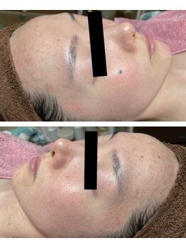 リラクゼーションサロン ラキ(laki)/お肌を育てるピーリング