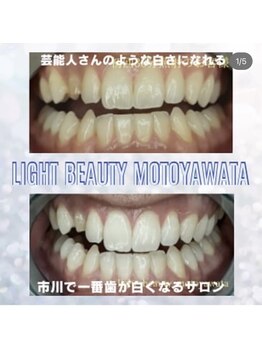 ライトビューティー 本八幡店(LIGHT BEAUTY)/キレイな歯になり笑顔も♪