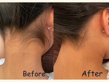 パッパ(PAPPA)/キッズは7歳から脱毛可能☆