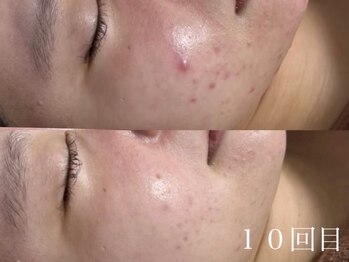 ホワイトアクア 四日市店(WHITE AQUA)/三重ララピール・水光肌・陶器肌