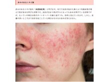 ベラ(VERA)の雰囲気(REVI陶肌トリートメント)