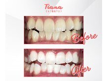 ティアナ(Tiana)/ホワイトニング　Before&After