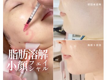 シュシュ(Chouchou)の写真/【小顔・二重あご】進化版レモンボトル×PLASMASTARでフェイスラインをキュッと引き上げ♪初回￥9,800