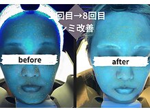 サロンスペース/30代女性　肌分析《シミ改善》