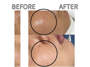 ライム 天神(LIME)/症例写真｜赤みケア、美白ケア