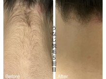 CDF 赤坂/全身脱毛うなじ５回目初回8800