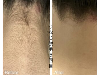 CDF 赤坂/全身脱毛うなじ５回目初回8800