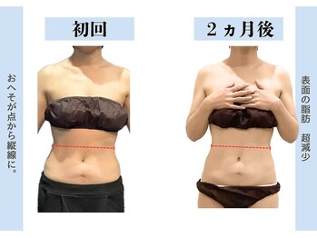 ビオラス 高崎店/脂肪減少ですっきりボディ♪