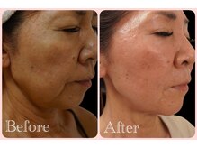 トータルビューティサロン クイーン(Queen)/●60代●フェイシャル