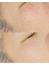 ナチュラル グロウ 木更津(NATURAL GLOW)/韓国最新機器プラズマ