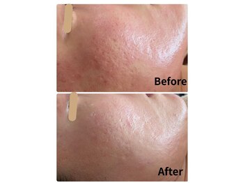 グロウスキン(GROW SKIN)/★赤み・キメ改善|肌育ケア