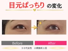 タイナ(taina)/30代女性/小顔施術1回
