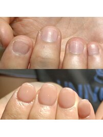 深爪矯正でナチュラルネイル