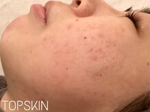 トップスキン 久屋大通(TOPSKIN)/肌管理はTOPSKINで♪