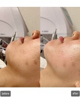 エムベル(M.belle)/リフトアップマッサージ施術前後