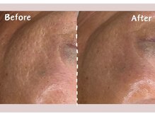 シー センター北(sii)/ララピール（施術後2週間）