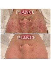 プランス 恵比寿店(PLANCE)/敏感肌の方にも