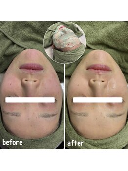 クラリ(Clari)の写真/【美白/透明感爆上げの最強マスク】期間限定ハイドロジェリーマスク全顔¥7700/背中orお尻or二の腕¥6600