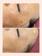 リファイン(REFINE)/ワントーンUP！シミケア改善