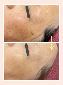 リファイン(REFINE)/ワントーンUP！シミケア改善