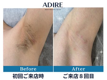 アディール(adire)/【ワキ脱毛】ビフォーアフター