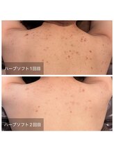 ビビ(VIVI)/背中のかゆみにも◎