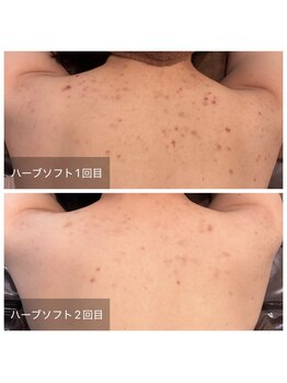 ビビ(VIVI)/背中のかゆみにも◎