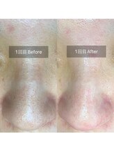 サロン リュンヌ(salon lune)/毛穴エクストラクション