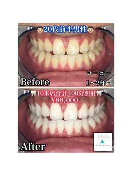 ホワイトニングビューティー 松戸店(Whitening Beauty)/ビフォーアフター