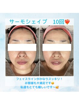 Nビューティー/最新RFサーモシェイプオーパス