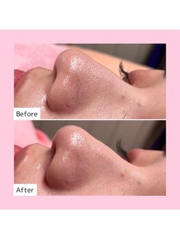 ホワイトラボ 岸和田店(White labo)/【施術例】ハイドロ毛穴洗浄