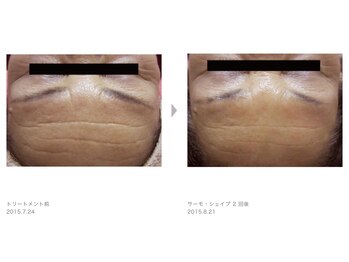 Nビューティー/最新RFサーモシェイプオーパス