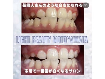 ライトビューティー 本八幡店(LIGHT BEAUTY)/小学生もホワイトニング♪