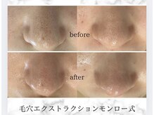 ビューティーブルーム(BeautyBloom)の雰囲気（鼻の黒ずみ汚れ、ザラつきには毛穴エクストラクションモンロー式）