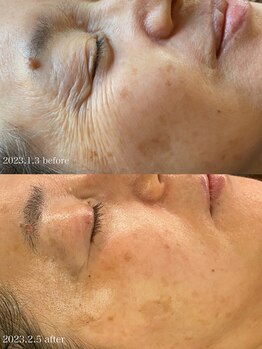 ラリマ(La-lima)/60代/シワケア