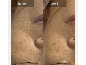 アリアサンティエ(Alia Scintiller)/純粋レチノールピール