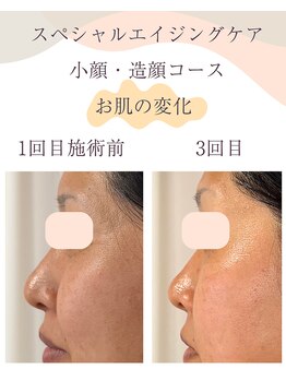 シンナリ(Shinnari)/お肌の変化