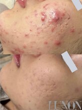 ルノン 天神店(LUNON)/ニキビ改善《経過》