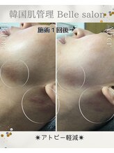 ベルサロン(Belle salon)/1度のケアで長年の敏感肌軽減