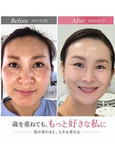 健美サロン ハナ(HANA)/ダイヤモンドピール・韓国肌ケア
