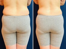 久留米スポーツ整骨院 整体院/エステ◆痩身インディバエステ