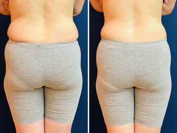 久留米スポーツ整骨院 整体院/エステ◆痩身インディバエステ