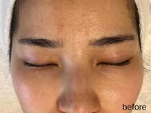 サロン ド エメ(salon de aimer)/【Before】本格エイジングケアに