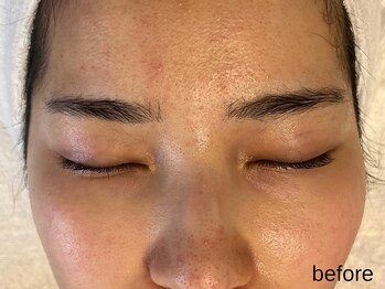 サロン ド エメ(salon de aimer)/【Before】本格エイジングケアに