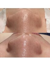 パルティール 渋谷店 partir/毛穴スッキリちゅるるんお肌に！