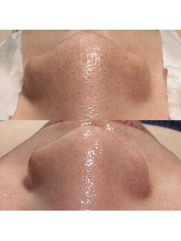 パルティール 渋谷店 partir/毛穴スッキリちゅるるんお肌に!