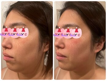 シェノン(Chainon)/独自のオールハンド筋膜リリース