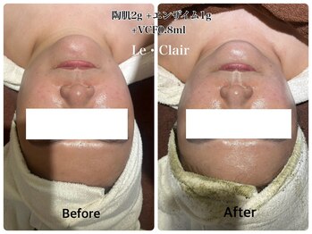 スキンセラピーサロン ル クレール(Le Clair)/Before→After